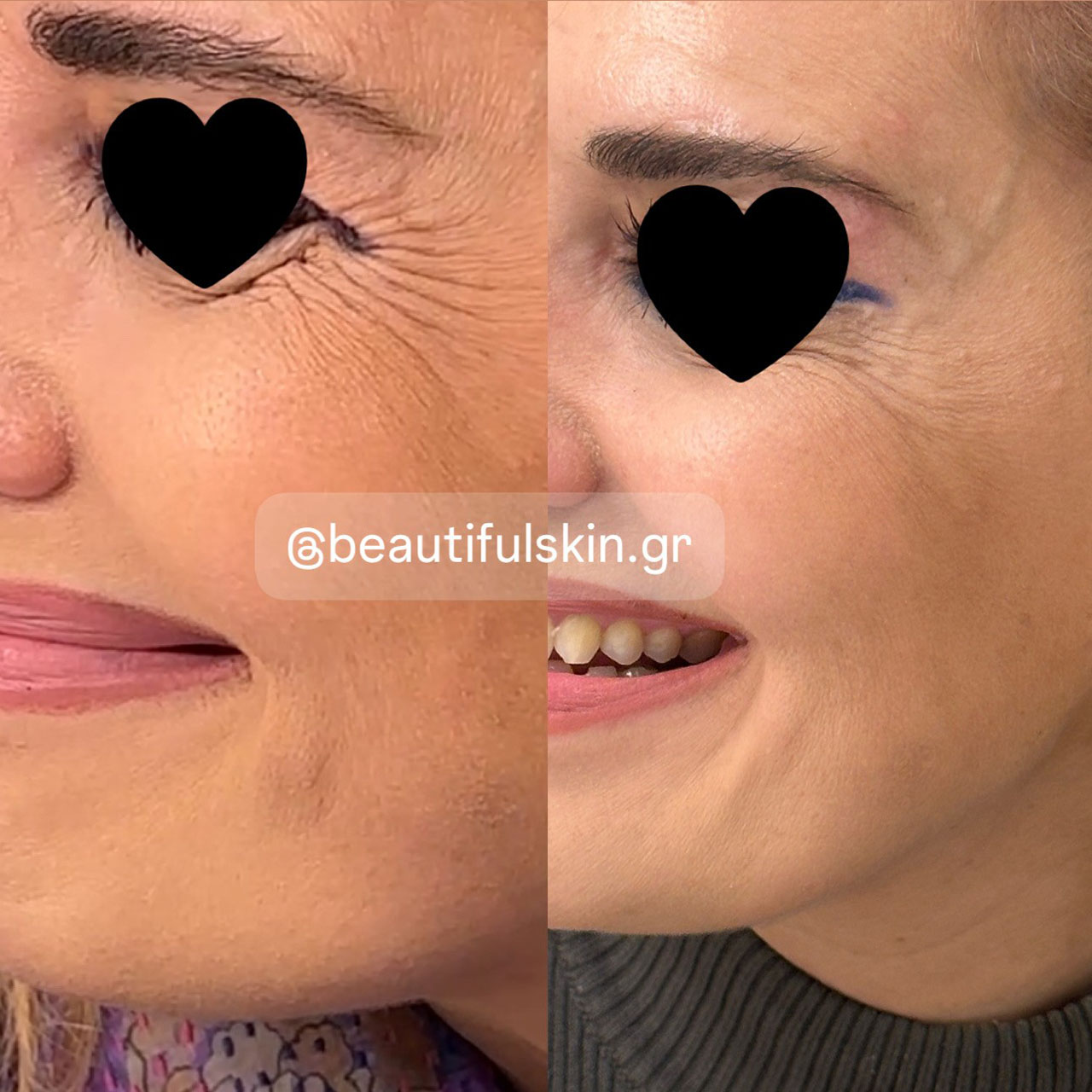 Θεραπείες για την περιοχή των ματιών