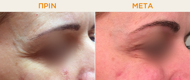 Πριν και μετά τη θεραπεία με Βοτουλινική τοξίνη στα μάτια