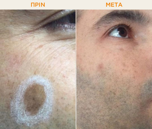 ΠΡΙΝ - ΜΕΤΑ: Πανάδα στο πρόσωπο πριν και μετά τη θεραπεία με λέιζερ.