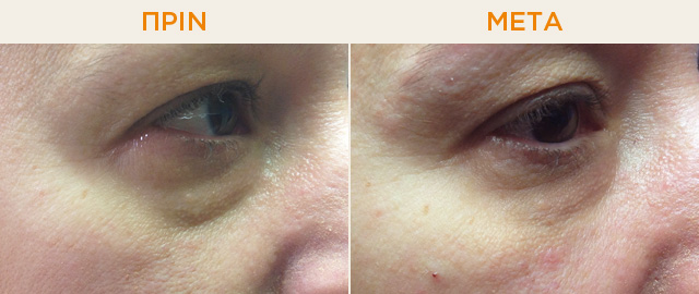 Dark Circles Before and after therapy with hyaluronic