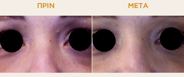 Dark Circles Before and after therapy