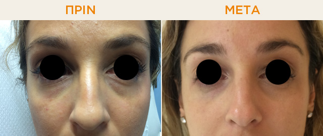 Dark circles Before and after the treatment